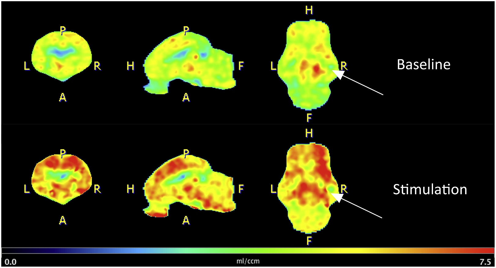 Published figure: [18F]GE-179 PET parametric images of one minipig brain in three views, baseline in the top row and during deep brain stimulation in the bottom row, on a colour scale of 0 to 7.5 millilitres per cubic centimetre. The stimulation images are much redder across the brain. Arrows mark a small increase on the implanted right side.